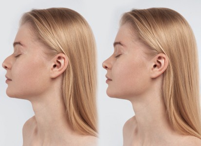 La rhinoplastie médicale, Dr Sarah Karelle