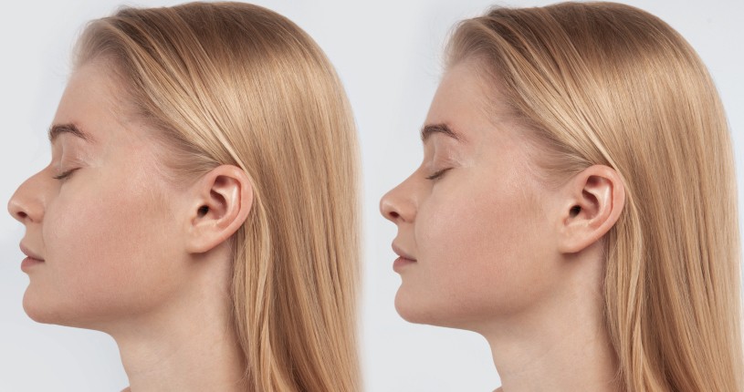 rhinoplastie médicale